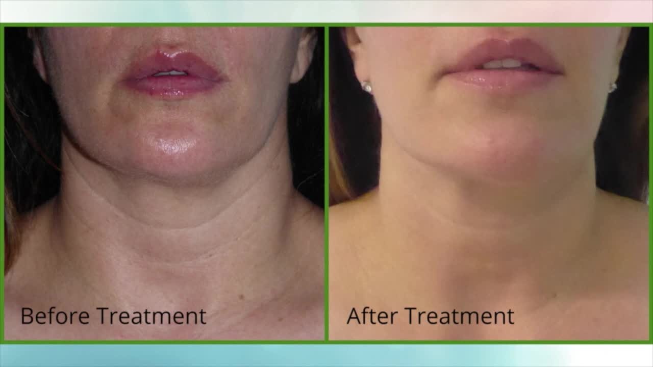 See the difference! Turn Back Time Spa & Wellness Clinic offers Vivace for your skin with great results