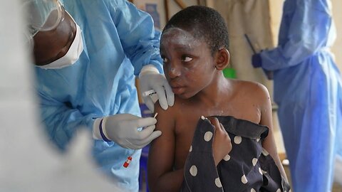 África registra más de 18.700 casos de mpox desde principios de año | AFP