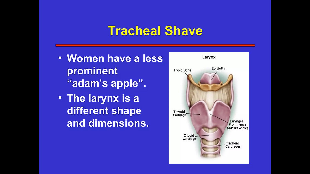 Tracheal Shave Transgender Studies