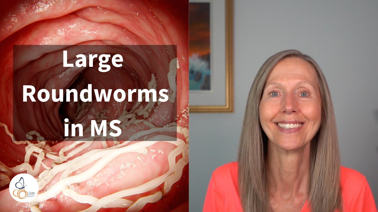 Large Roundworms in MS