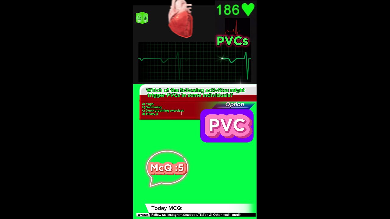 PVC #pvc #arrthymias #cardaic #heart prematureventricle tachycardia