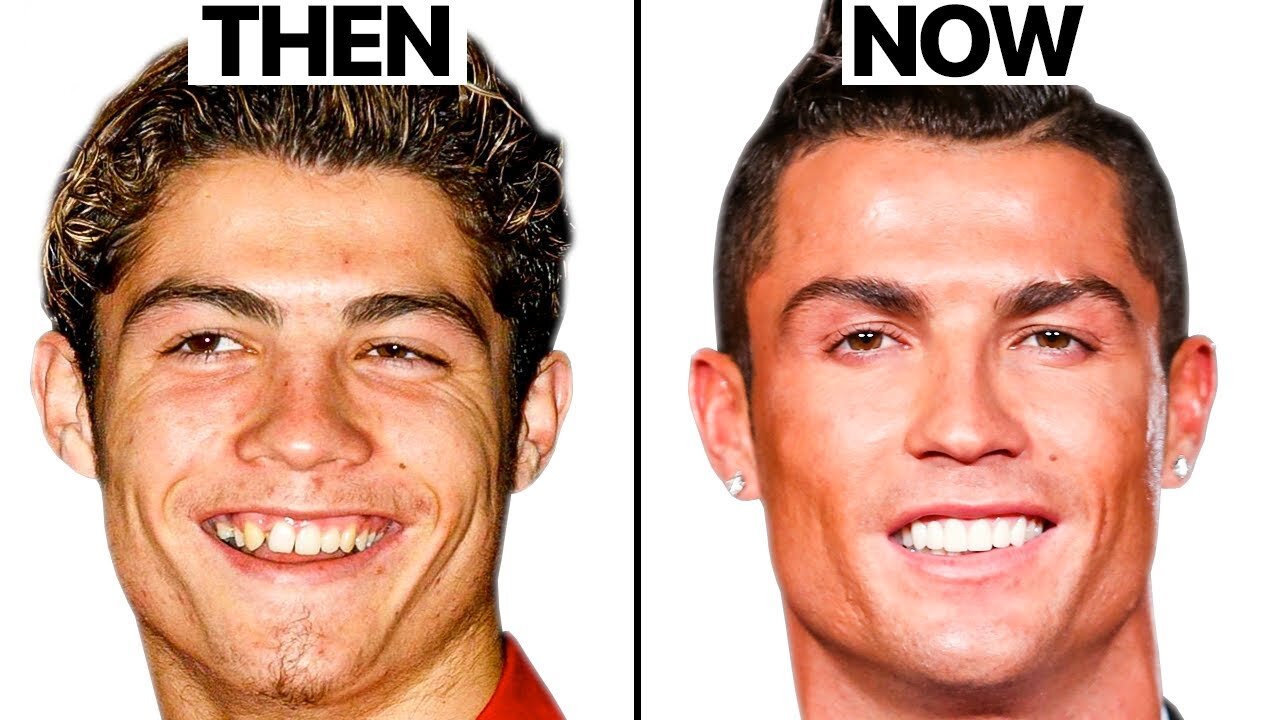 Cristiano Ronaldo new face plastic surgery enalysis