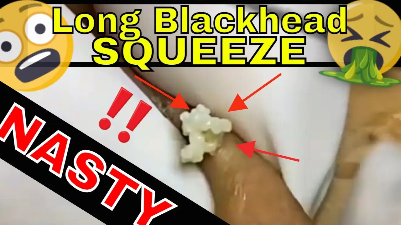 Nasty long blackhead squeeze and a short one at the end 😳 #blackheadremoval #blackhead #blackheads