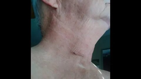 ACDF Recovery-- 1 Month