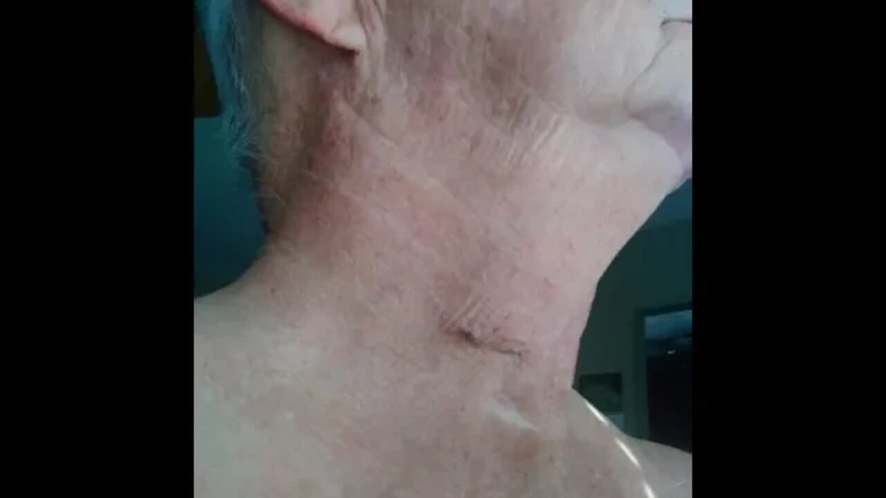 ACDF Recovery-- 1 Month