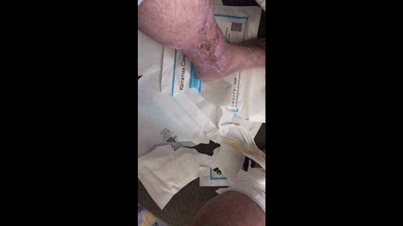 Ulceration legs