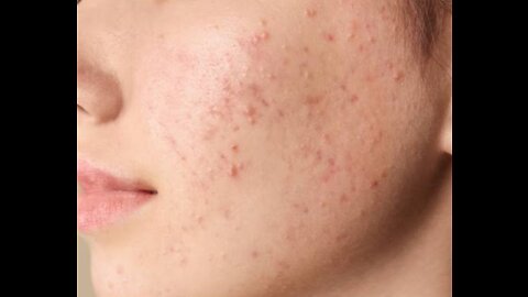 Acne skin treatment through home remedy