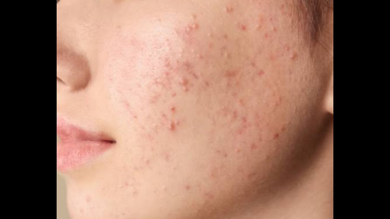 Acne skin treatment through home remedy