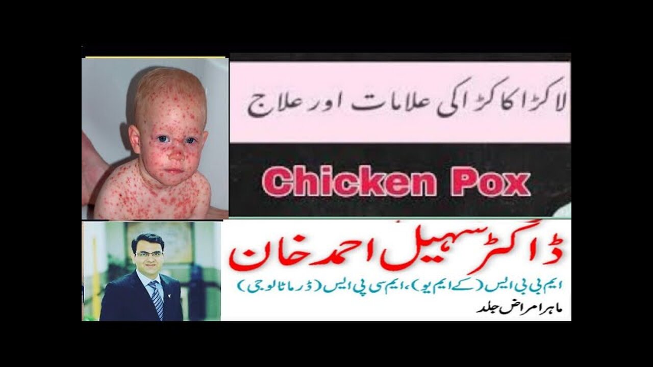 Chicken Pox Treatment