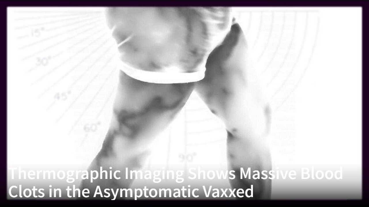 Thermographic Imaging Shows Massive Blood Clots in the Asymptomatic Vaxxed