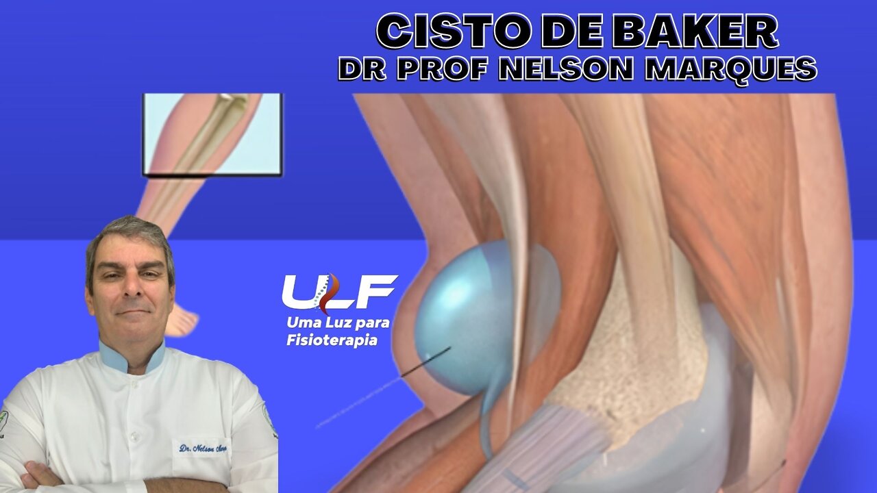 CISTO DE BAKER - Dr. Prof. Nelson Marques