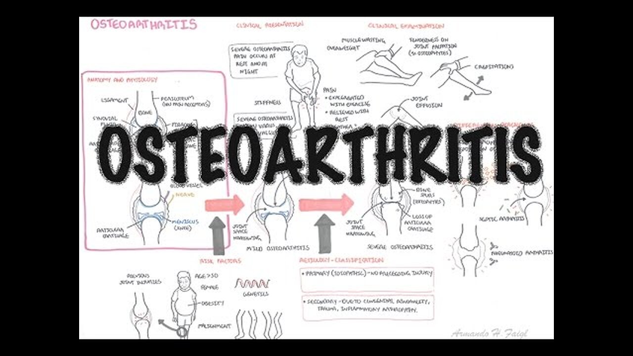 Osteoarthritis Overview (causes, pathophysiology, investigations, treatment)