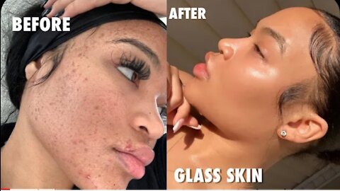 HOW I CLEARED MY ACNE FOR GOOD IN ONE WEEK (NO ACCUTANE) + SKINCARE GIVEAWAY | SKINCARE ROUTINE 2020