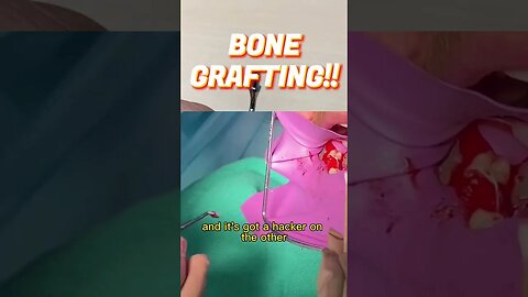 Bone Graft Tip (Game-changer) #dentist