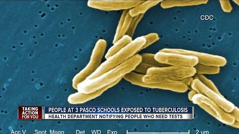 People at 3 Pasco schools exposed to Tuberculosis