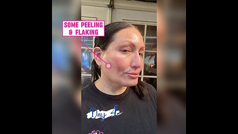 Update Day 4 on VI Peel Precision Plus 💁🏻‍♀️Read Description For Coupon Link