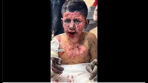 ►🚨▶◾️🇮🇱⚔️🇵🇸 Gaza Wounded Die Slowly. There are no Doctors