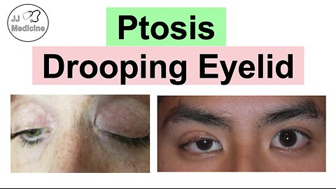 Ptosis (Drooping Eyelid) | Eye Anatomy, Causes, Associated Conditions, Diagnosis & Treatment