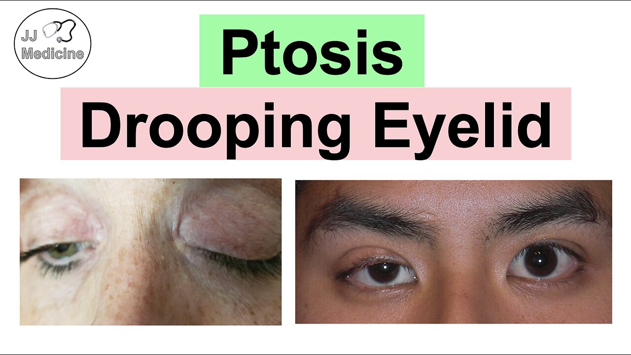 Ptosis (Drooping Eyelid) | Eye Anatomy, Causes, Associated Conditions, Diagnosis & Treatment