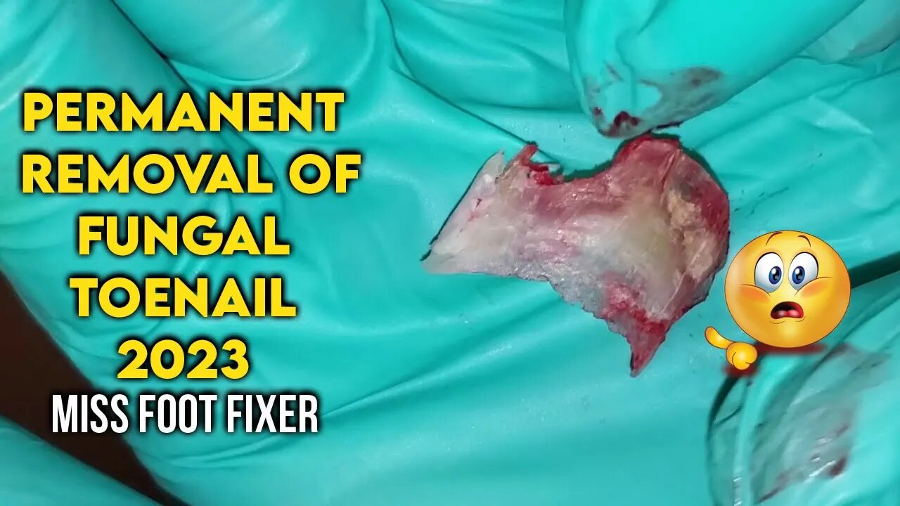 PERMANENT REMOVAL OF FUNGAL NAIL [ DAMAGED NAIL ] BY FAMOUS PODIATRIST MISS FOOT FIXER