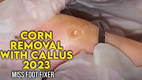 CORN REMOVAL WITH CALLUS - 🦶 [ FOOT DOCTOR MISS FOOT FIXER TREATMENT 2023]