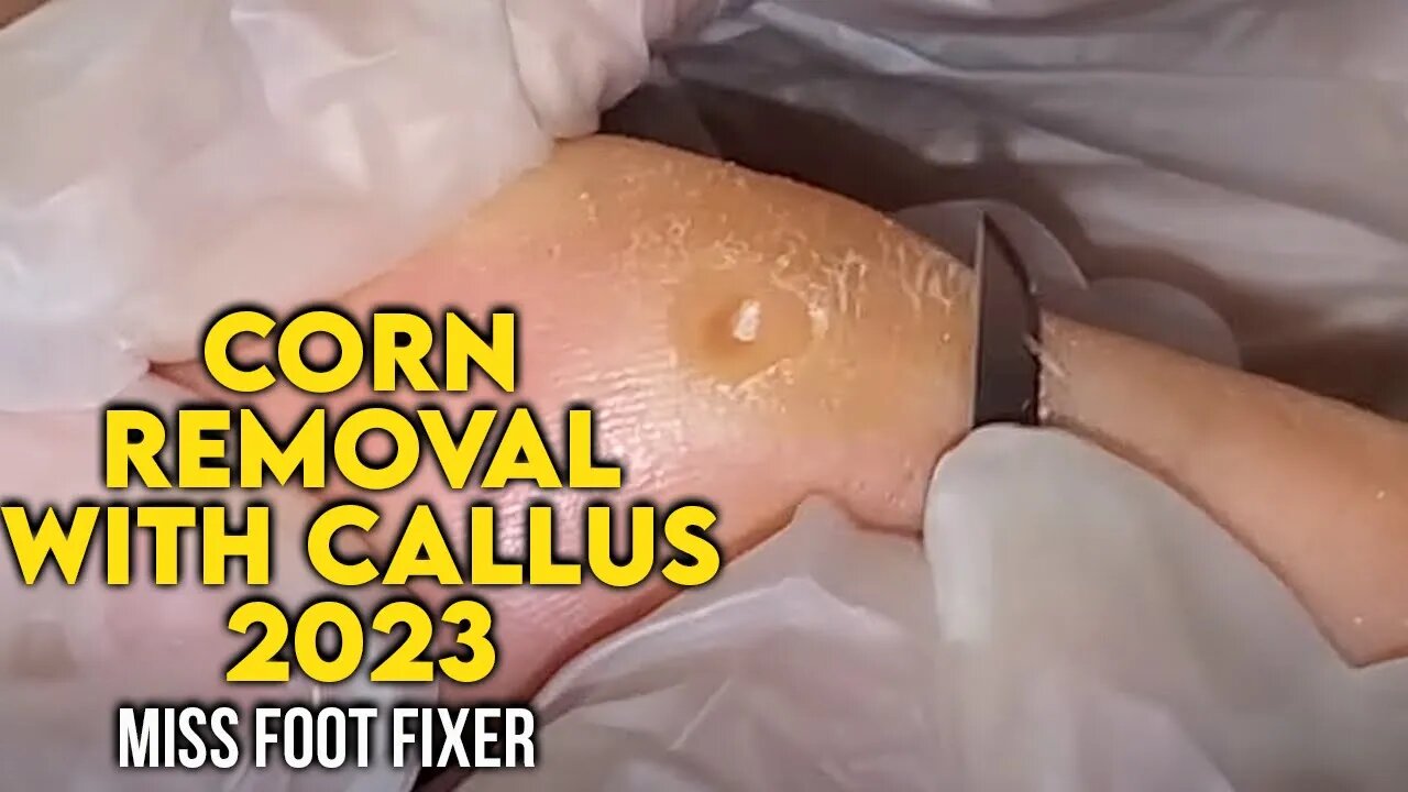 CORN REMOVAL WITH CALLUS - 🦶 [ FOOT DOCTOR MISS FOOT FIXER TREATMENT 2023]