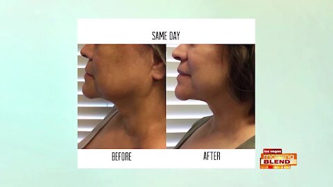 Your Face Lift Alternative