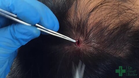 Complete Removal of an Intact Pilar Cyst