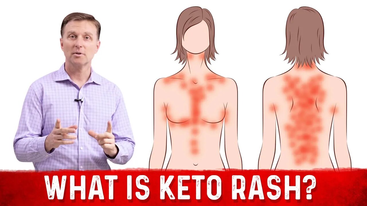 What is Keto Rash? - Dr. Berg