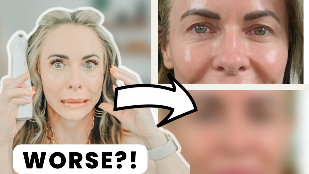 NIRA Skincare Laser | Does the Before & After Make Eyes Look Worse