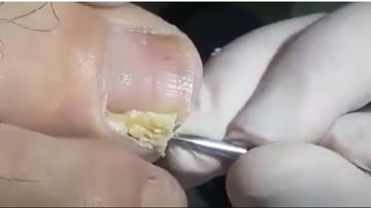 Big Ingrown Toenail Removal!!!!