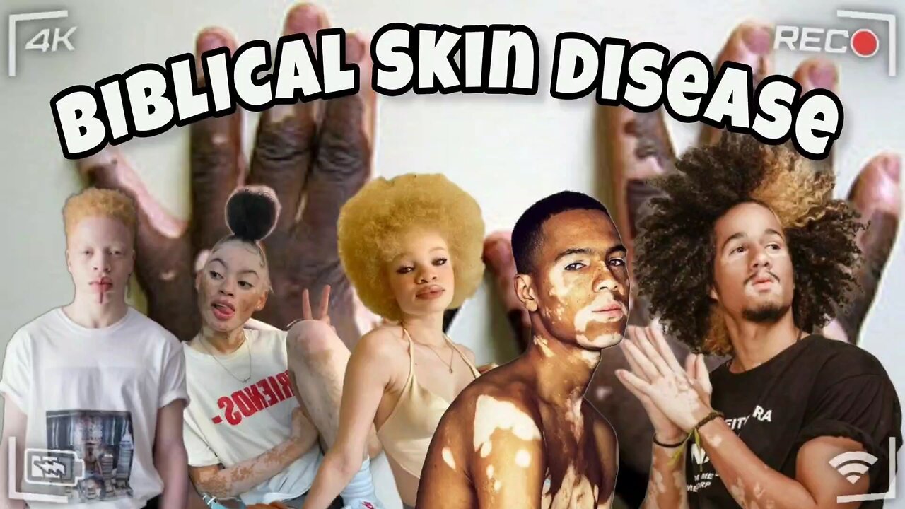 Biblical Skin Pigmentation Disorder - Clean leprosy (Bible study)