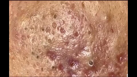 Massive Whiteheads Blackheads!