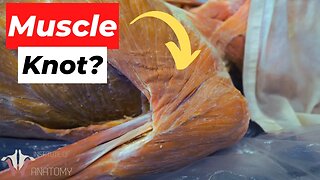 What EXACTLY Are Muscle Knots??