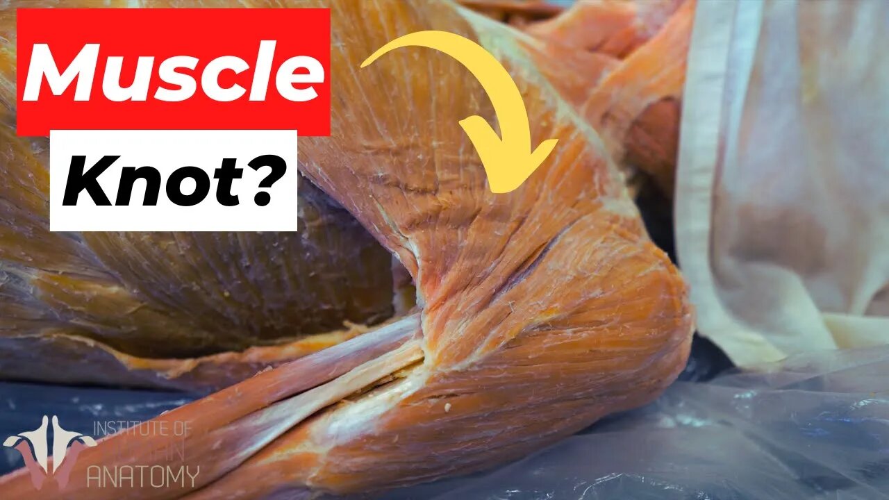 What EXACTLY Are Muscle Knots??