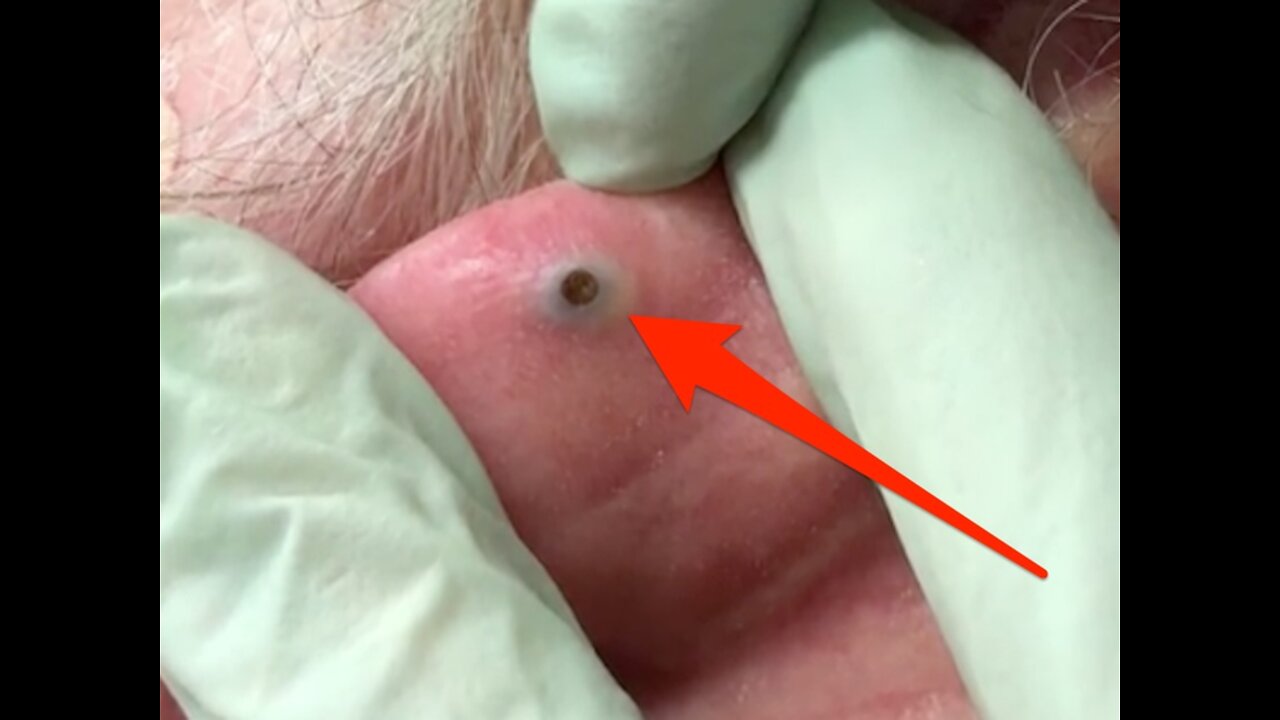 Pimple popping compilation | most popular