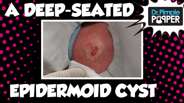 Proof Cysts are often Bigger than they Appear!