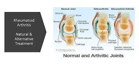 Rheumatoid Arthritis - Natural Treatment