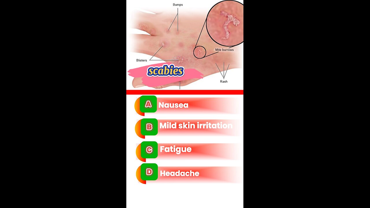 Scabies question answers mcqs #Scabies #skin #allergyproblems #drugs #pharmacology ##health