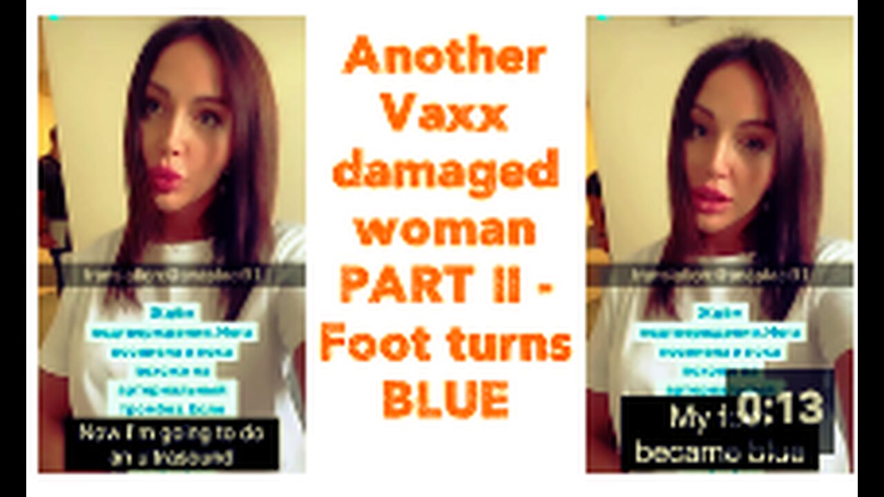 Another Vaxx damaged woman PART II | Foot turns BLUE