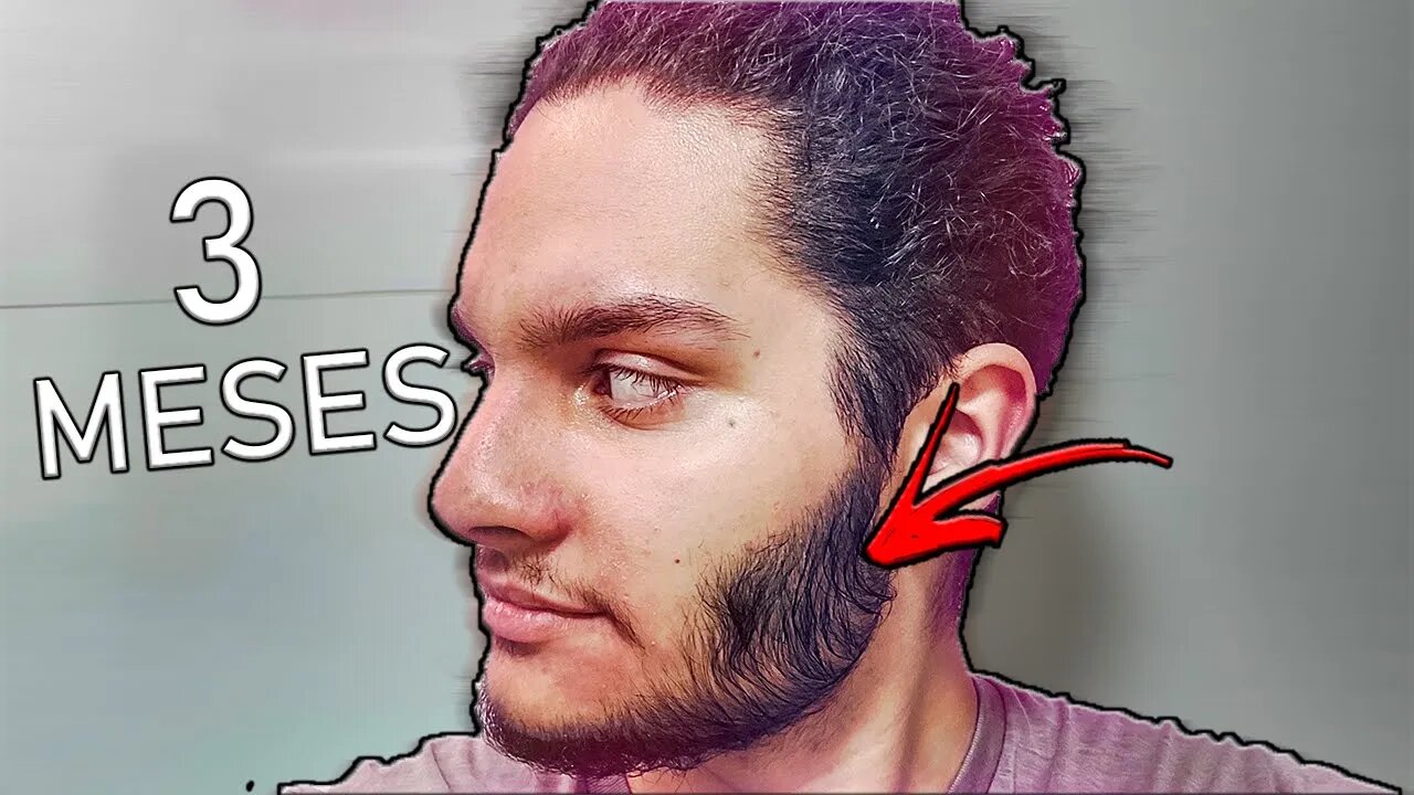 3 MESES USANDO MINOXIDIL