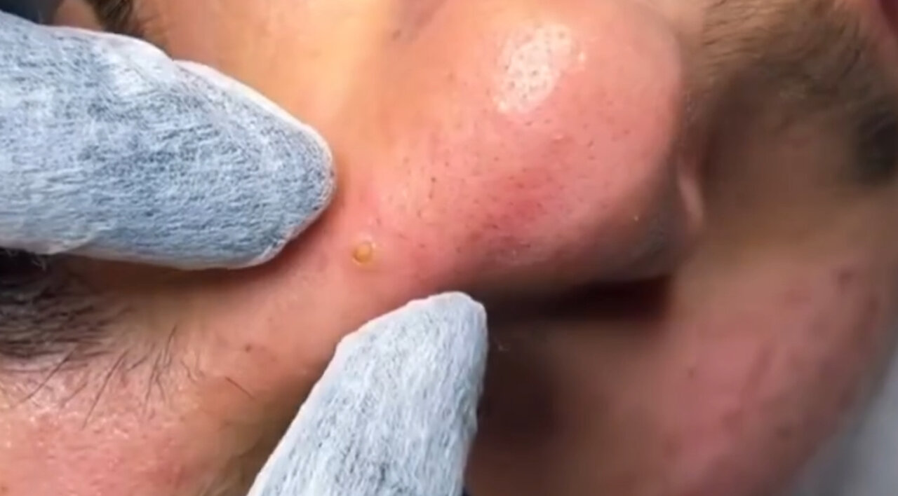 BLACKHEADS Facial Cleaning | SATISFYING