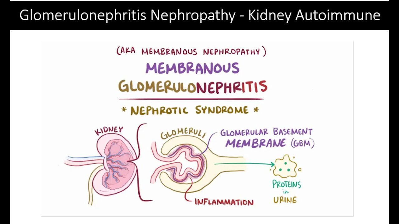 Kidney Autoimmune Glomerulonephritis Nephropathy - Natural Treatment