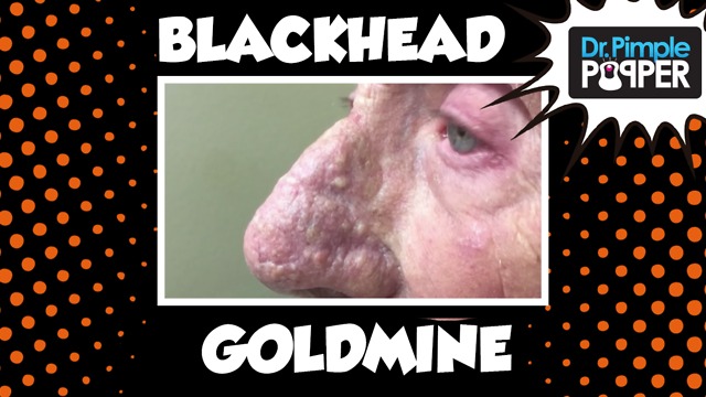 Dr Pimple Popper: A Goldmine of Blackhead & Whitehead Extractions