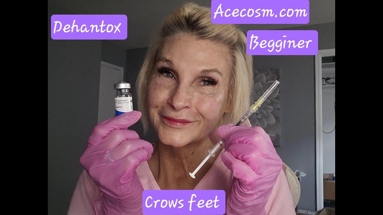 Botox crows feet Acecosm.com DIY55 Dehantox