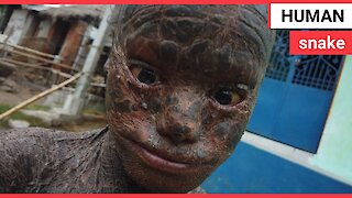 Ten-year-old boy dubbed 'human snake' due to rare skin condition