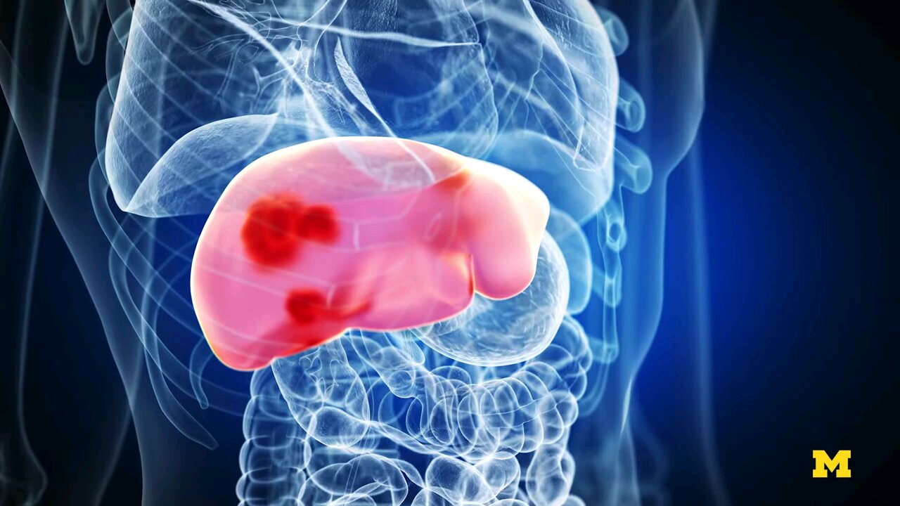 Ultrasound Being Used To Destroy Cancer Tissue