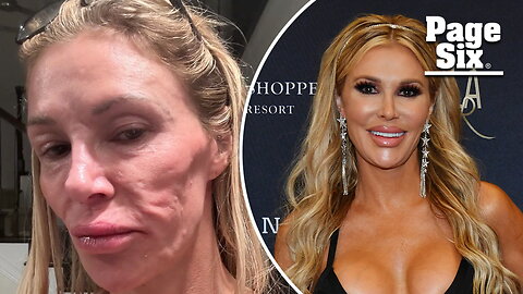 Brandi Glanville 'lost 5 teeth' while battling facial disfigurement