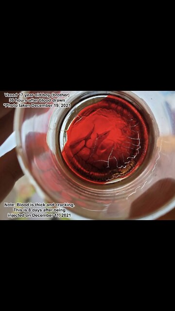 ‘Vaccine’ BioWeapon Destroys The Blood And Circulation? ● Download PDF Link Below