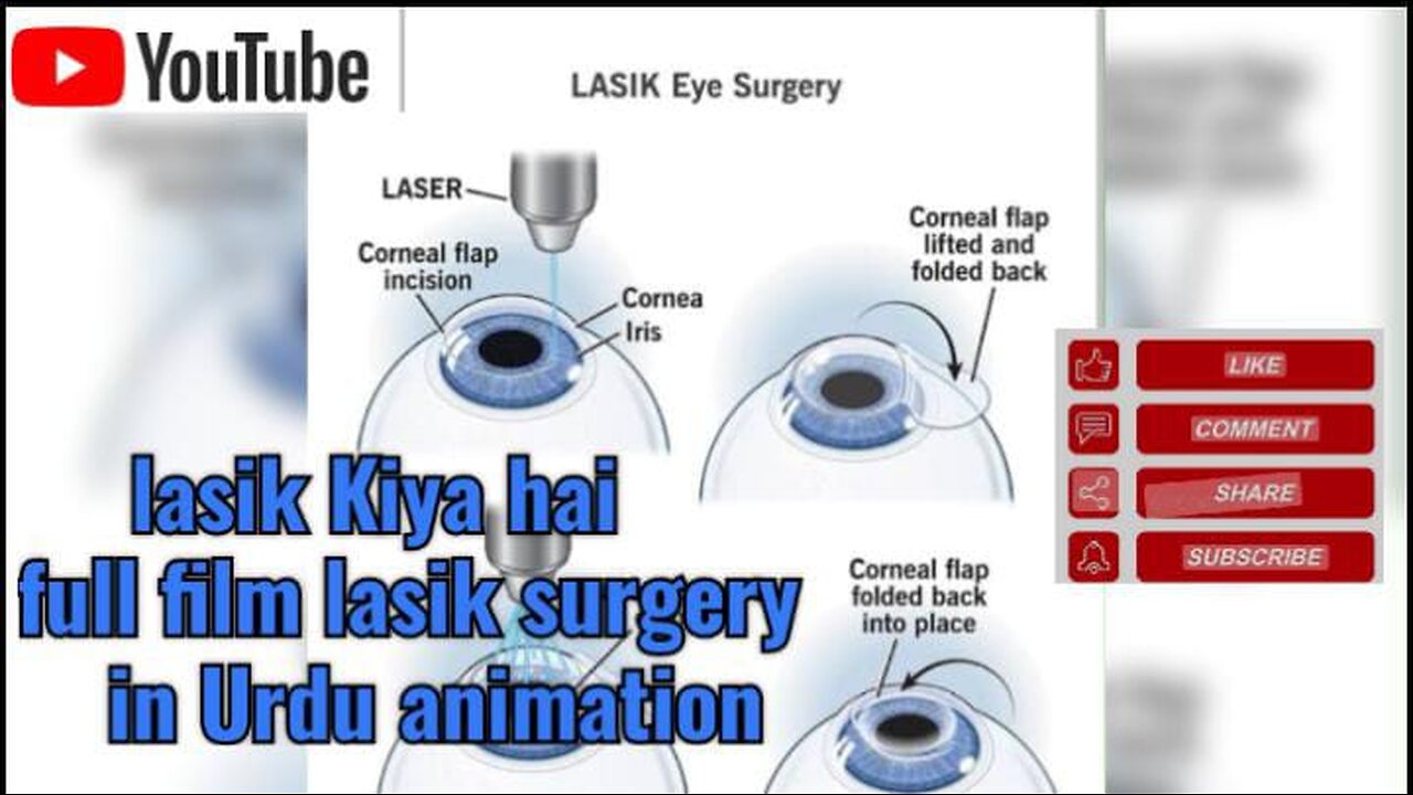 lasik kiya hai | lasik sugery | glasses se nijat | Transform Your Vision